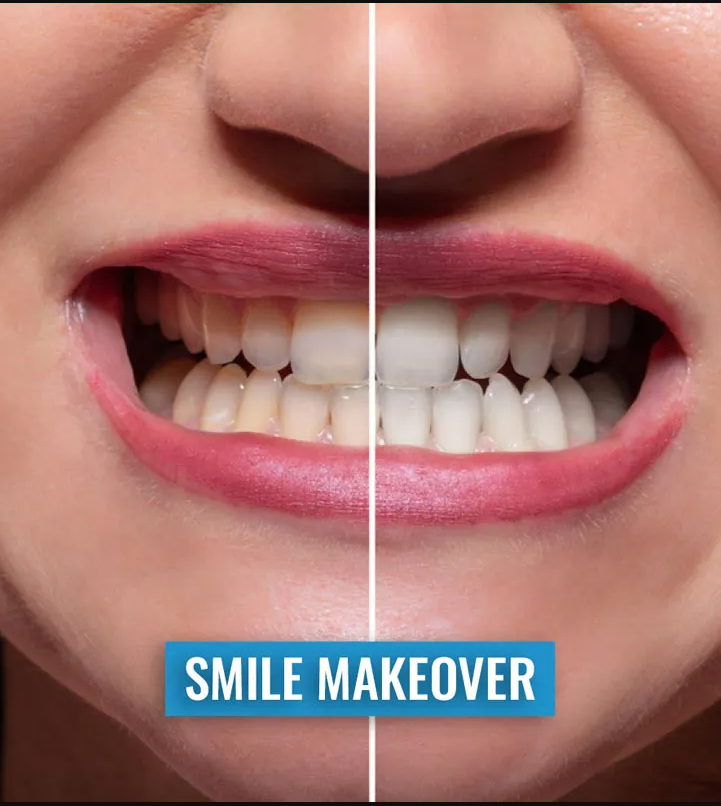 Smile makeover transformation